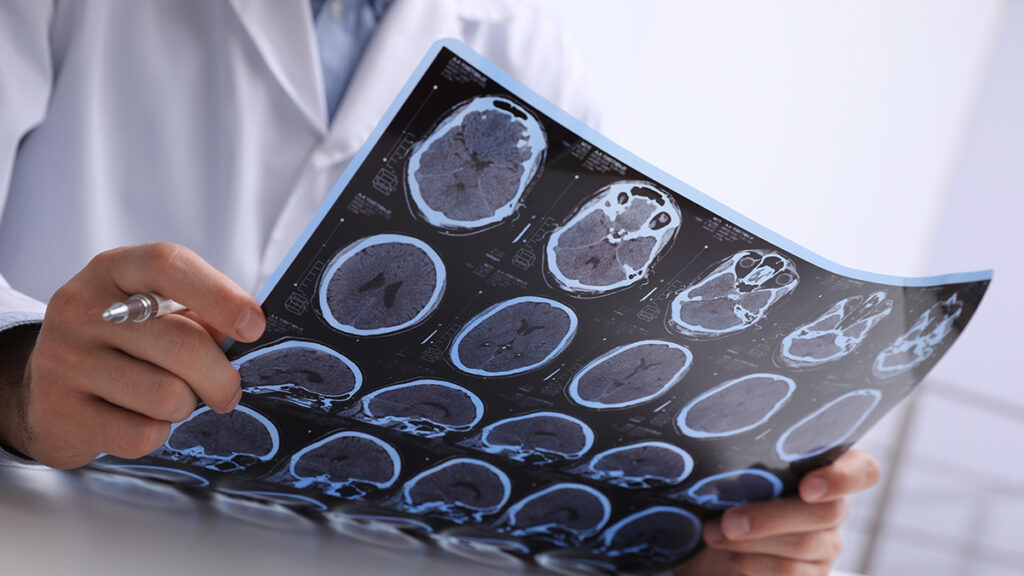 Traumatic-Brain-Injury-Team-Green-Law 1 | Team Green Law Doctor reviews a chart of someone involved in a motorcycle accident and suffering from a traumatic brain injury accident.